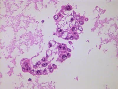 Example Cell block example immunohistochemistry