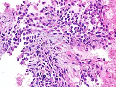 Example Cell block example immunohistochemistry