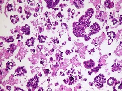 Example Cell block example immunohistochemistry