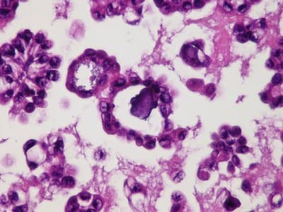 Example Cell block example immunohistochemistry