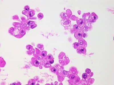 Example Cell block example immunohistochemistry