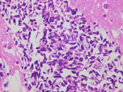 Example Cell block example immunohistochemistry