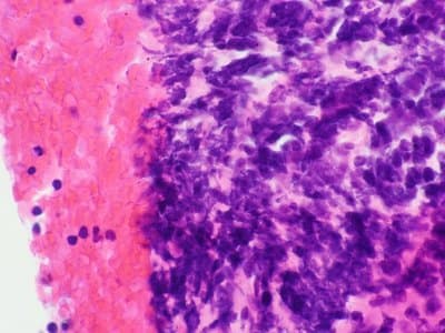 Example Cell block example immunohistochemistry
