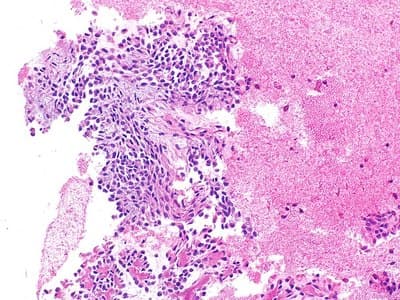 Example Cell block example immunohistochemistry