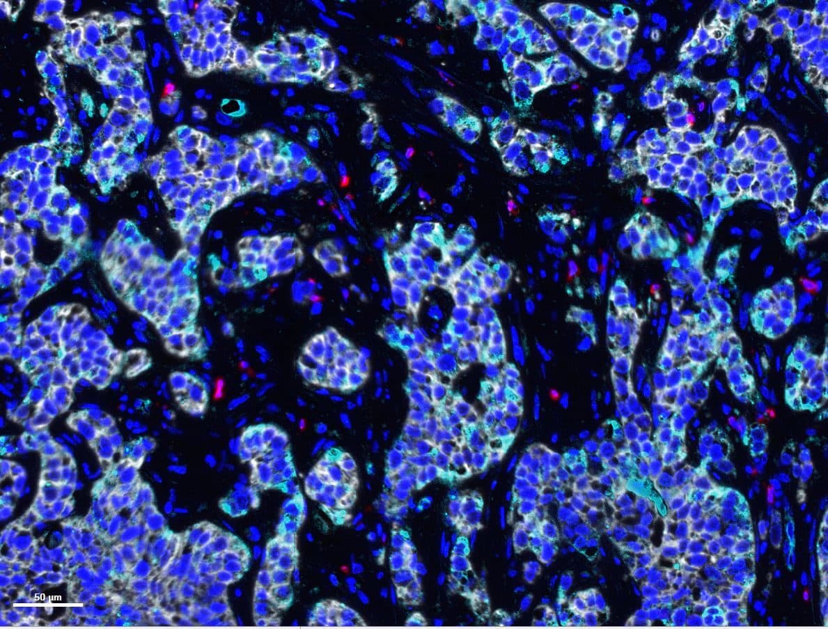 Multiplex immunofluorescence: tumor